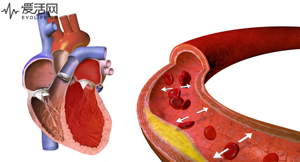 Blausen_0486_HighBloodPressure_01